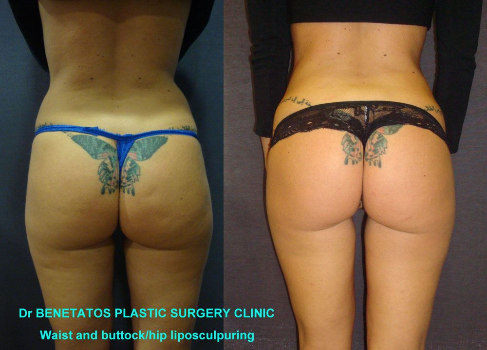AestheticBodySurgery Liposuction 1